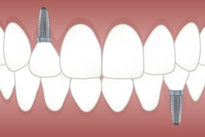 Implantat // ADAMIETZ & KOLLEGEN GmbH